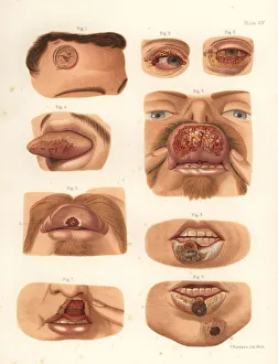 Syphilitic chancres on the face Syphilitic chancres on the face
