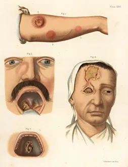 Tertiary period syphilis symptoms on the body Tertiary period syphilis symptoms on the body