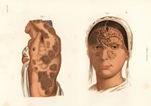 Tubercular syphilis symptoms on the body Tubercular syphilis symptoms on the body