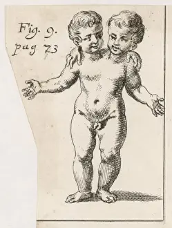 Two-Headed Child Print, 1691 Pavia Birth