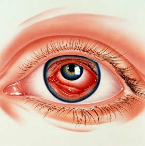 Abstract illustration of eye with conjunctivitis Abstract illustration of eye with conjunctivitis