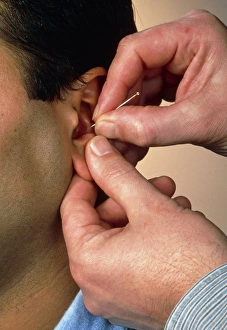 Acupuncture Treatment Prints: Acupuncturists hands insert needle into mans ear