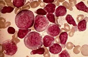 Acute Leukaemia Print