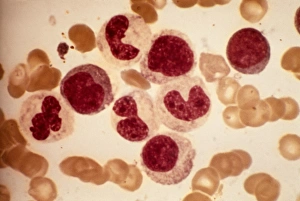 Images Dated 22nd February 2013: Acute Leukaemia Print - Bone Marrow Blood Cells