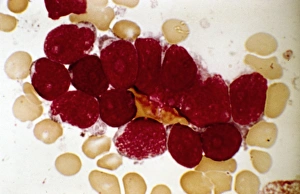 Acute Lymphoblastic Leukaemia Print