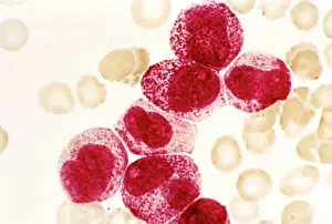 Acute promyelocytic leukaemia, micrograph Acute promyelocytic leukaemia, micrograph