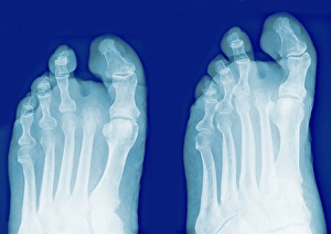 Prints of Amputated toe. Coloured frontal (left) and oblique (right). X-rays of the foot of a diabetic with an amputated second toe Images Dated 2011 May: Amputated Toe X-ray Print