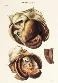 Images Dated 2007 January: Aortic Aneurysm Print
