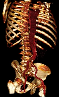 Prints of Aortic dissection. 3D computed tomography (CT) scan of a 67-year-old man with an aortic dissection. The aorta, the bodys main artery, is running vertically down centre (red) Images Dated 2008 March: 3D CT Scan Print of Aortic Dissection