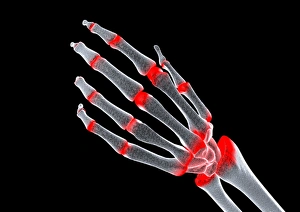 Rheumatoid Arthritis Symptoms Prints: Arthritic hand