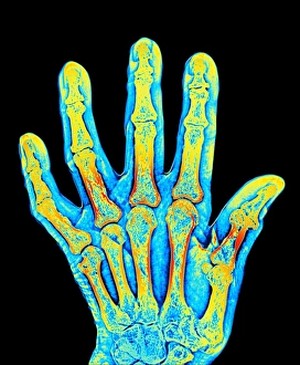 Rheumatoid Arthritis Symptoms Prints: Arthritic hand bones