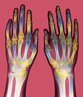 Rheumatoid Arthritis Symptoms Prints: Arthritic hands, X-ray