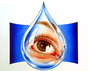 Artwork of an eye with conjunctivitis in tear drop Artwork of an eye with conjunctivitis in tear drop