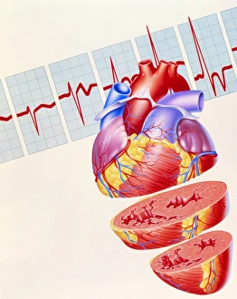 Artwork of heart & ECG trace in heart failure Artwork of heart & ECG trace in heart failure