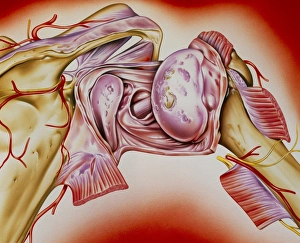 Artwork of an rheumatoid arthritis of the shoulder Artwork of an rheumatoid arthritis of the shoulder