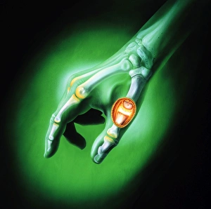 Artwork showing arthritis of a thumb joint Artwork showing arthritis of a thumb joint