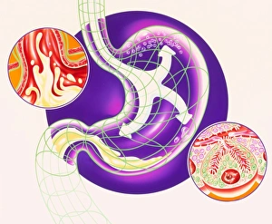 Artwork showing dyspepsia & acid reflux treatment Artwork showing dyspepsia & acid reflux treatment