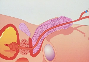 Artwork showing urinary catheterisation Artwork showing urinary catheterisation