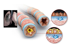 Prints of Asthma pathology. Computer artwork showing cross-sections through a normal airway (right) and an asthmatic, constricted airway (left) Images Dated 2010 December: Asthma Pathology Print