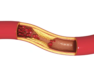 Atherosclerosis Symptoms Prints: Atherosclerosis, artwork