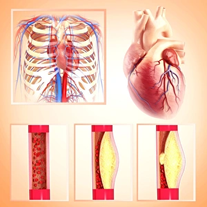 Atherosclerosis Print: Narrowed Artery with Cholesterol Plaque