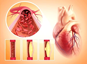 Atherosclerosis Print: Narrowed Artery with Cholesterol Plaque