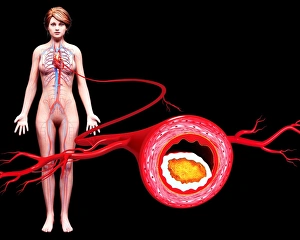 Atherosclerosis Print - Cross-section of a blood vessel with plaque buildup