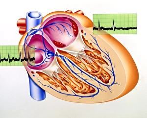 Atrial fibrillation, artwork Atrial fibrillation, artwork