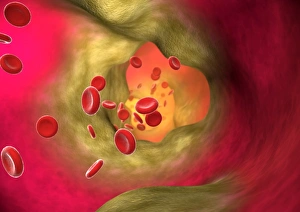 Atherosclerosis Symptoms Prints: Blocked artery