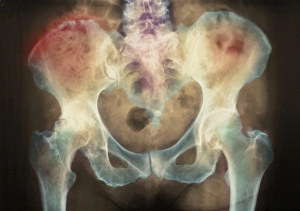 Coloured X-ray Print of Osteonecrosis in the Pelvic Girdle