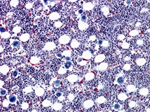 Prints of Bone marrow, light micrograph. The large blue cells are megakaryocytes, which form platelets. Dark purple cells are erythroplastic islets, which form red blood cells Images Dated 2010 March: Bone Marrow Print, x150 Magnification