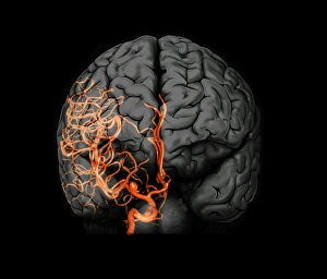 3D CT Angiogram Print of a Brain Aneurysm