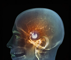 Images Dated 27th March 2013: Large right internal carotid artery aneurysm Print