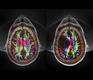 Brain cancer, DTI and 3D CT scans C016/6414 Brain cancer, DTI and 3D CT scans C016/6414