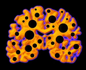 Brain damage Brain damage