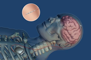 Deep Brain Stimulation Prints: Brain pacemaker, artwork