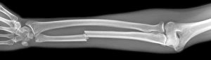 Xray Prints: X-ray Print of a Fractured Ulna in a 29-year-old Male