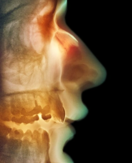 Prints of Broken nose. Coloured X-ray of a side view of a mans head showing a broken nose (upper centre). The fracture of the nasal bone appears as a thin line Images Dated 2004 February: Coloured X-ray Print of a Broken Nose