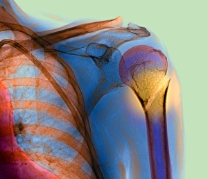 Coloured X-ray Print of a Fractured Humerus
