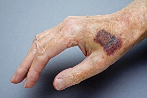Prints of MODEL RELEASED. Bruised hand. Bruising on a persons hand Images Dated 2008 April: Bruised Hand Print