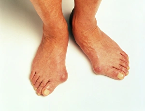 Prints of Bunions. Each of these fluid-filled pads covers the joint of the big toe Images Dated 2003 February: Bunion Print, a close-up of fluid-filled pads on the big toe joint