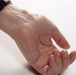 Prints of Inflamed bursa on the wrist of an elderly woman. A bursa is a fluid-filled sac present at points in the body where skin, muscles and tendons slide across bone Images Dated 2005 July: Inflamed Bursa on Wrist Print
