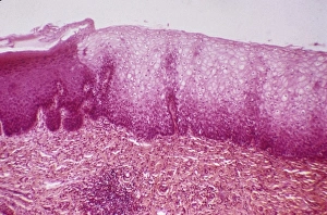 Cervical thickening, light micrograph C015/6167 Cervical thickening, light micrograph C015/6167