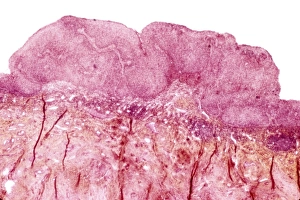 Light Micrograph Images Prints: Cervical wart, light micrograph C015 / 6747