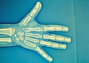 Child hand X-ray Child hand X-ray