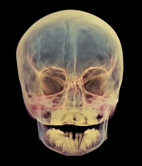 Coloured X-ray Print of a Child's Skull