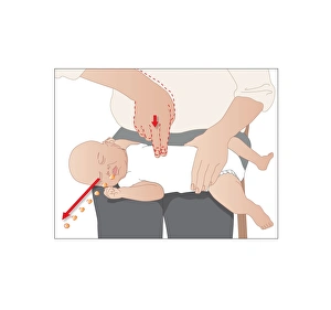 Choking First Aid Print