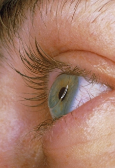 Close-up of an eye wearing a hard contact lens Close-up of an eye wearing a hard contact lens