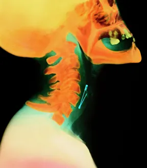 Col X-ray of object (safety pin) lodged in throat Col X-ray of object (safety pin) lodged in throat