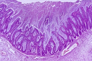 Images Dated 27th March 2013: Pseudomembranous Colitis Print, x13 magnification